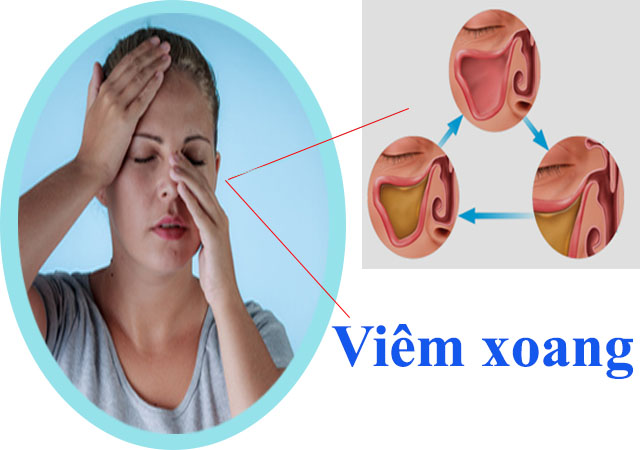 Tìm hiểu về bệnh viêm xoang