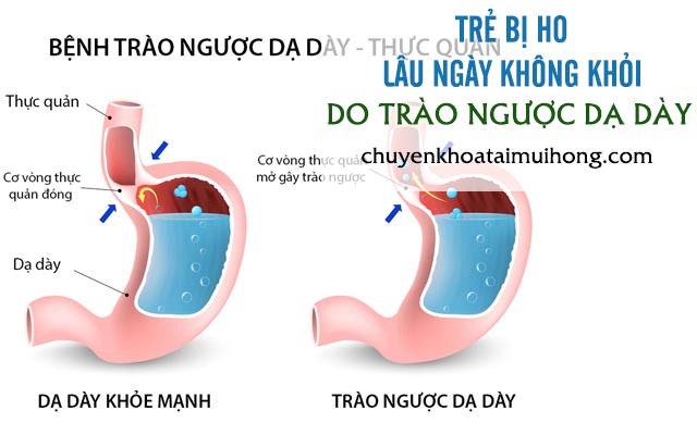 Trào ngược dạ dày thực quản cũng là nguyên nhân chính gây ho kéo dài