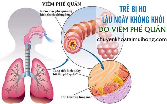 Trẻ bị ho lâu ngày không khỏi do viêm phế quản