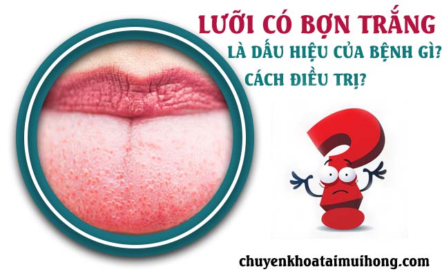 Lưỡi có bợn trắng là dấu hiệu bệnh gì? Nên làm gì để điều trị?