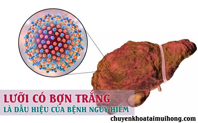 Lưỡi có bợn trắng có thể là dấu hiệu của bệnh nguy hiểm