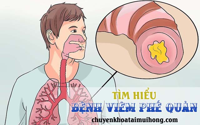 Tìm hiểu bệnh viêm phế quản