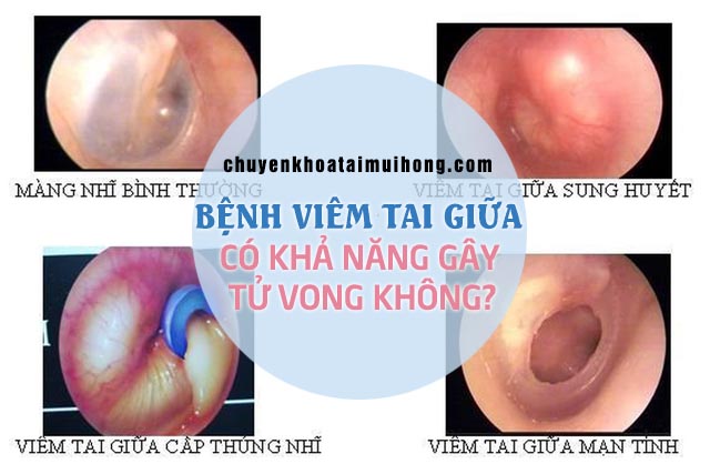 Bệnh viêm tai giữa có nguy hiểm không?