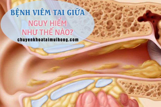 Bệnh viêm tai giữa có nguy hiểm như thế nào?