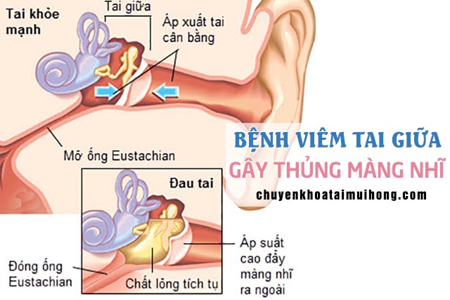 Thủng màng nhĩ do viêm tai giữa