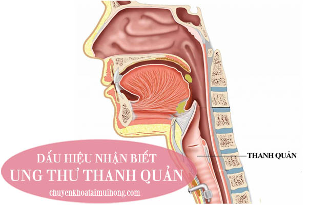 Dấu hiệu bệnh ung thư thanh quản 