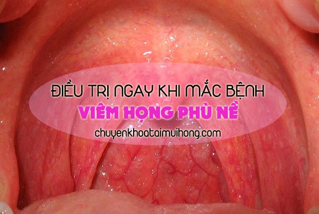 Bệnh viêm họng phù nề