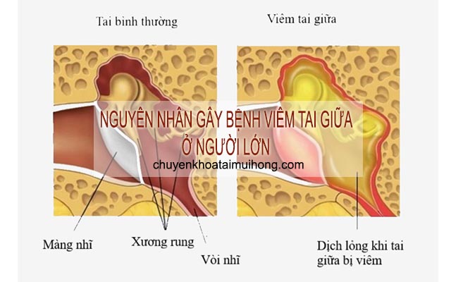 Nguyên nhân gây bệnh viêm tai giữa ở người lớn