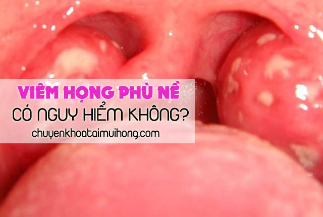 Bị viêm họng phù nề có nguy hiểm không?