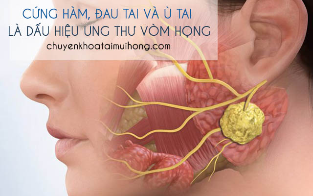 Ung thư vòm họng gây cứng hàm, đau tai và ù tai