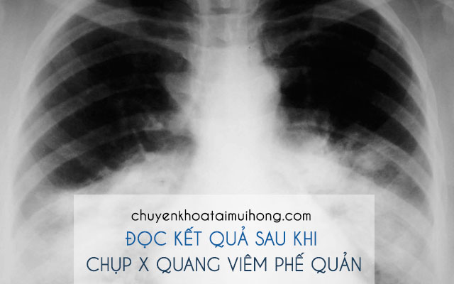 Kết quả sau khi chụp X quang viêm phế quản