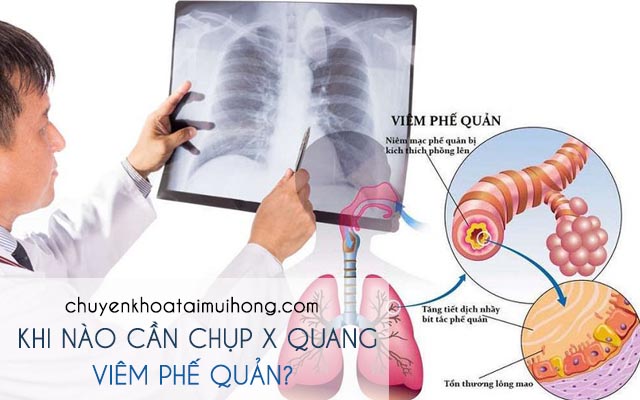 Khi nào cần chụp X quang viêm phế quản?