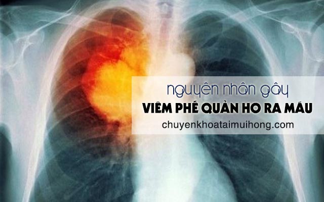 Nguyên nhân dẫn đến viêm phế quản ho ra máu 