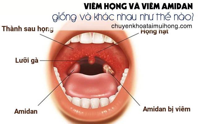 Viêm amidan và viêm họng có giống và khác nhau như thế nào?