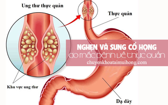 Bệnh lý về thực quản gây nghẹn và sưng cổ họng