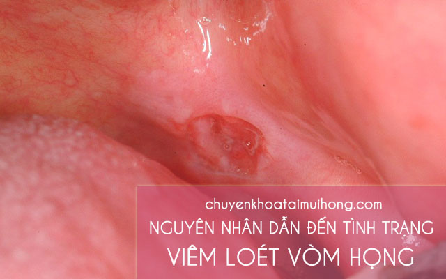 Nguyên nhân dẫn đến viêm loét vòm họng