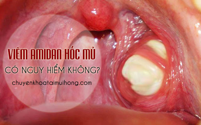 Bệnh viêm amidan hốc mủ có nguy hiểm không?