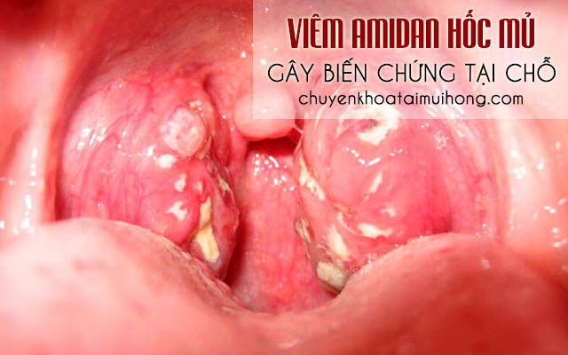 Viêm amidan hốc mủ gây biến chứng tại chỗ