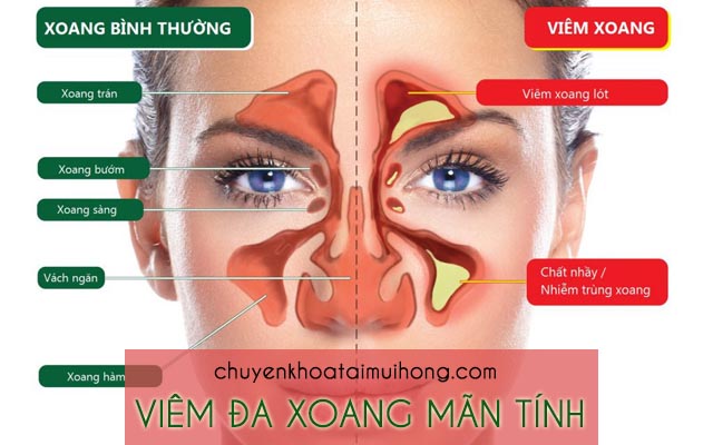 Bệnh viêm đa xoang mãn tính