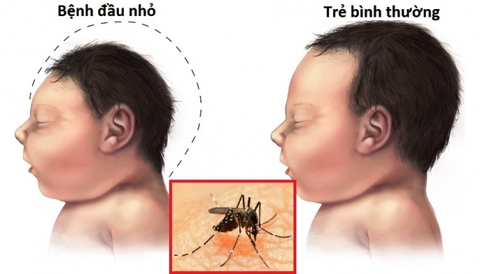 4-bieu-hien-nhiem-cum-zika-ban-can-biet-2