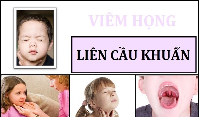 Bệnh viêm họng liên cầu khuẩn và những điều cần biết