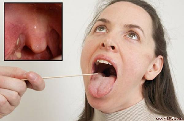 Ô mai có thể chữa trị được bệnh viêm họng, giảm triệu chứng đau rát họng
