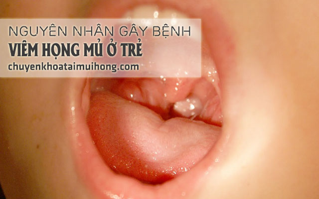 Nguyên nhân gây viêm họng mủ ở trẻ