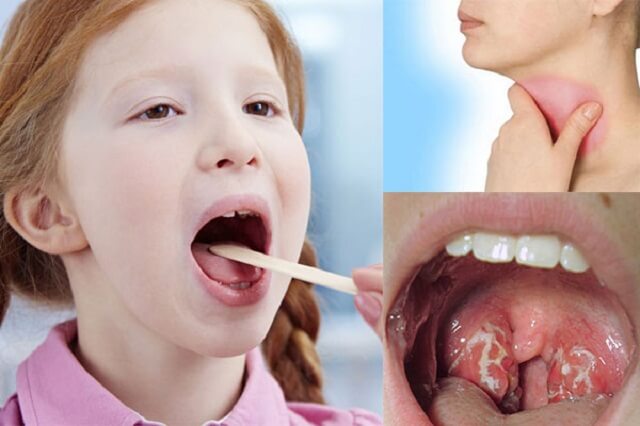 Tránh xa ngay những loại thực phẩm này khi bị viêm họng Tránh xa ngay những loại thực phẩm này khi bị viêm họng