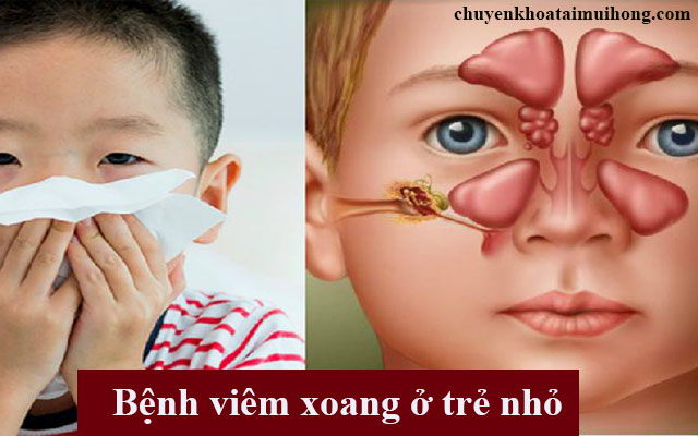 Viêm xoang khiến trẻ xì máu ở mũi