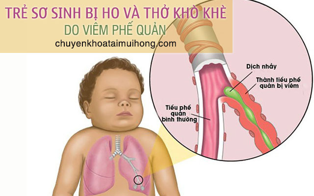 Bệnh viêm phế quản khiến trẻ sơ sinh bị ho và thở khò khè 