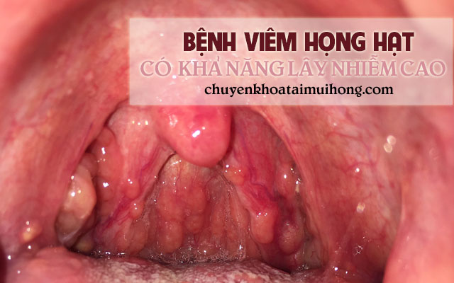 Bệnh viêm họng hạt có khả năng lây nhiễm vô cùng cao