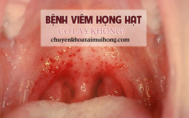 Viêm họng hạt có lây không ?
