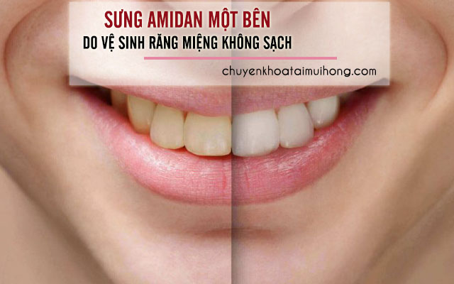 Sưng amidan một bên do chế độ ăn uống và không vệ sinh răng miệng sạch sẽ