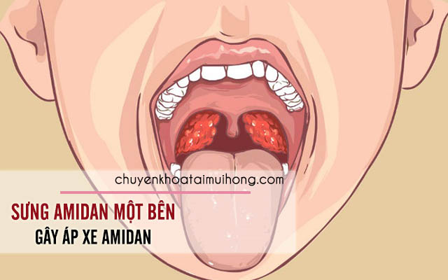 Sưng amidan một bên gây nên biến chứng áp xe amidan