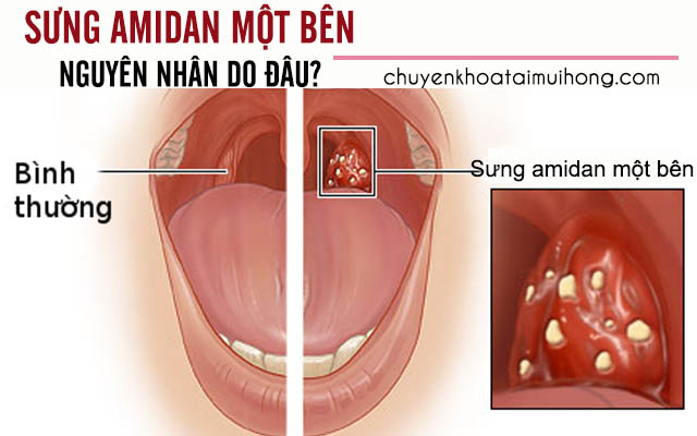 Nguyên nhân gây sưng amidan một bên