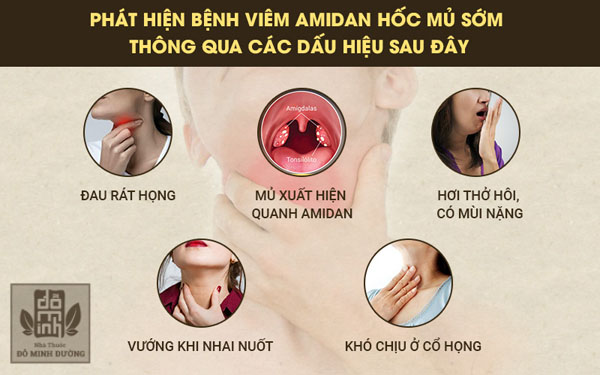 Sớm phát hiện viêm amidan hốc mủ thông qua các dấu hiệu sau Sớm phát hiện viêm amidan hốc mủ thông qua các dấu hiệu sau