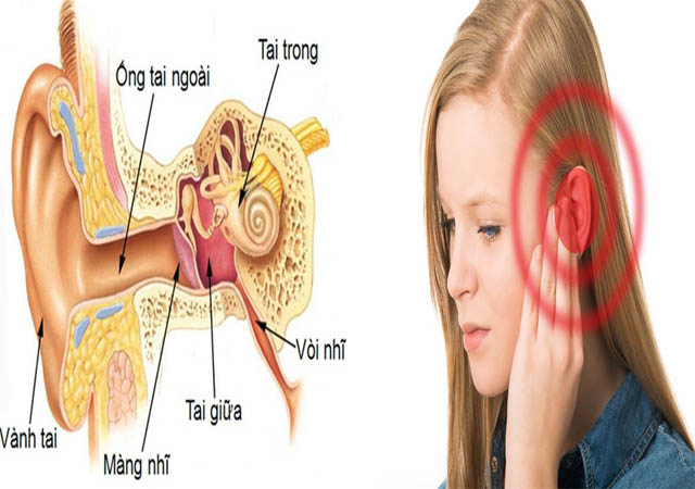 Bệnh viêm tai giữa là gì? Bệnh viêm tai giữa