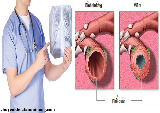 Bệnh viêm phế quản