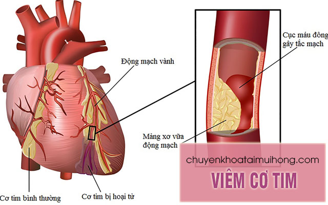 Bệnh viêm họng bạch hầu gây biến chứng viêm cơ tim