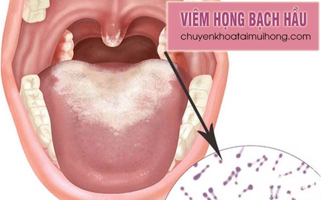 Bệnh viêm họng bạch hầu: Nguyên nhân, triệu chứng và cách điều trị