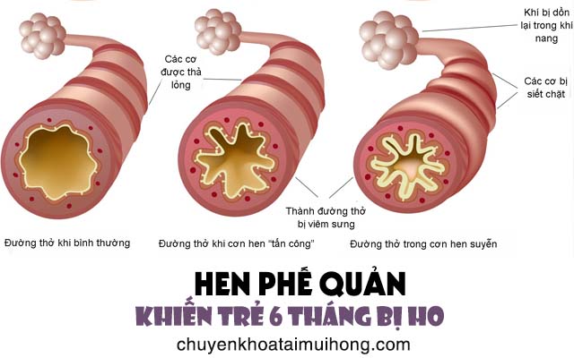 Hen phế quản khiến trẻ 6 tháng bị ho