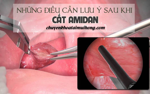 Sau khi cắt amidan cần kiêng gì?