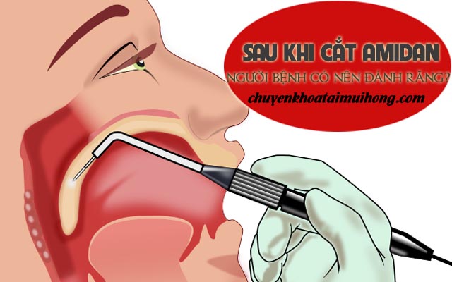 Sau khi cắt amidan người bệnh có nên đánh răng không?