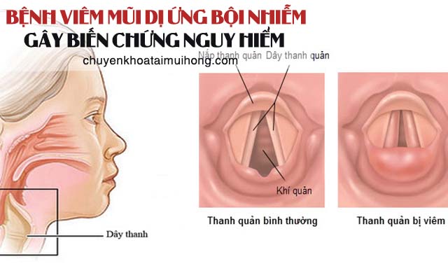 Viêm mũi dị ứng bội nhiễm gây biến chứng nguy hiểm