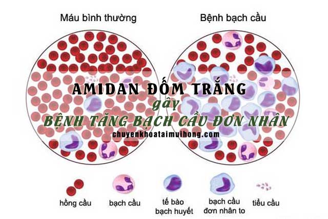 Amidan đốm trắng gây bệnh tăng bạch cầu đơn nhân