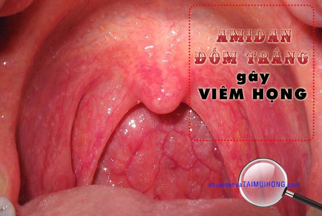 Amidan đốm trắng gây bệnh viêm họng