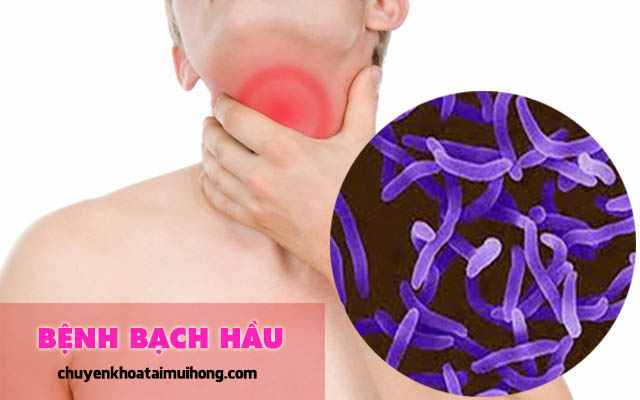 Phân biệt cụ thể viêm họng và bệnh bạch hầu