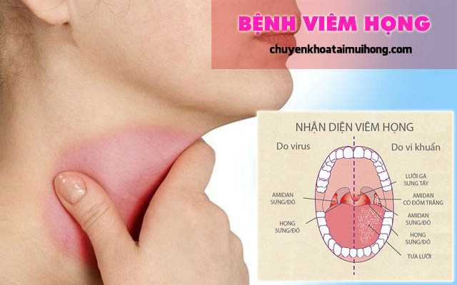 Phân biệt cụ thể viêm họng và bệnh bạch hầu