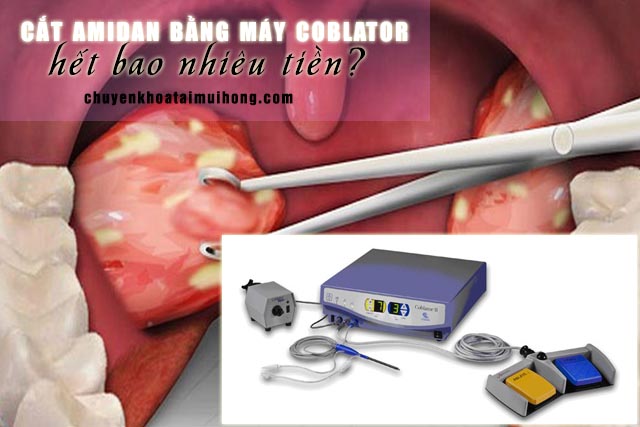 Cắt amidan bằng máy Coblator hết bao nhiêu tiền?