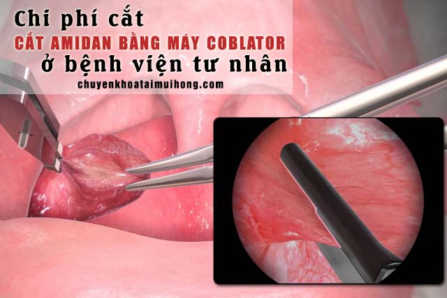 Mức chi phí cắt amidan bằng máy Coblator ở bệnh viện tư nhân 